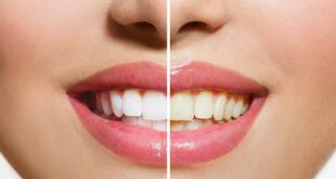 تاثير يائسگي بر سلامت دهان و دندان