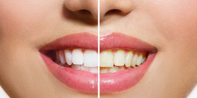 تاثير يائسگي بر سلامت دهان و دندان
